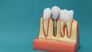 How Dental Implants Work A Singapore Patient’s Guide